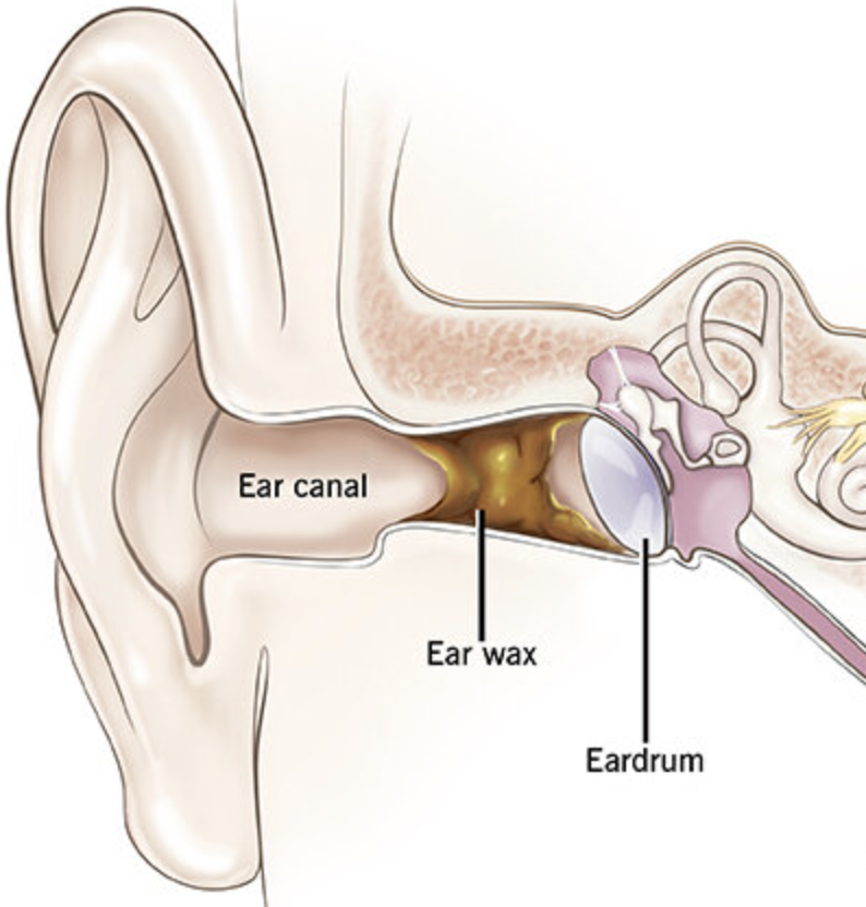 Impacted Ear Wax - MODO Mobile Doctor Urgent Care